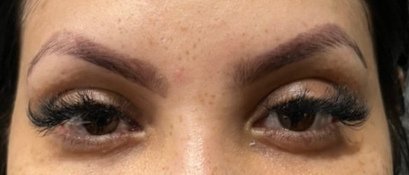 After Botox eyebrow lift