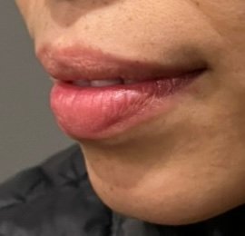After Botox lip flip2