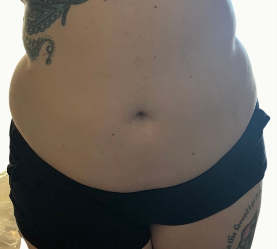 After photos one treatment session 2