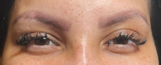Before Eyebrow lift Before Eyebrow lift