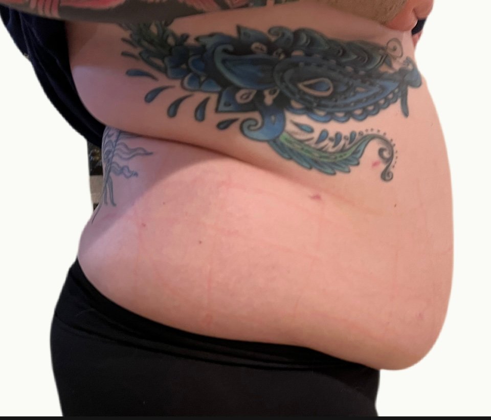 Before photos one treatment session 1