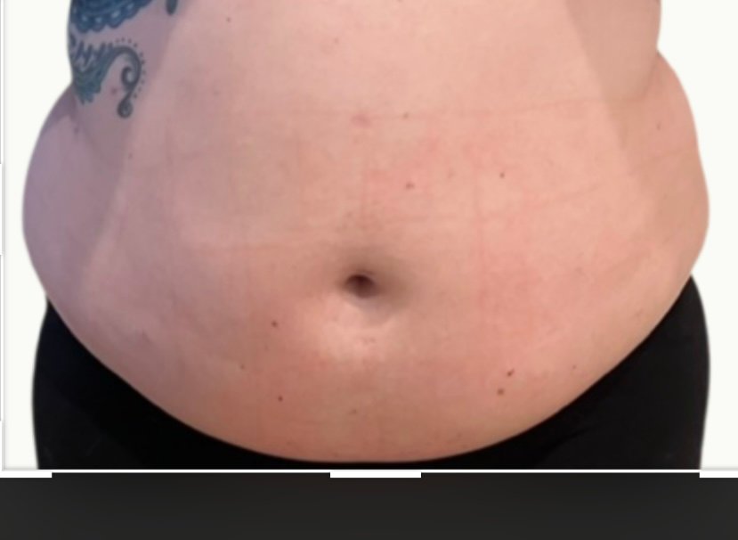 beforephotos one treatment session 2